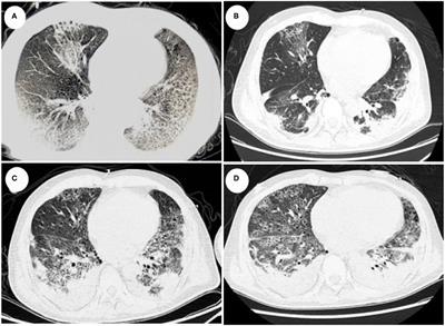 Frontiers  Early Detection of Legionella pneumophila and Aspergillus